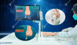 留置针操作视频,轻松掌握静脉穿刺技巧